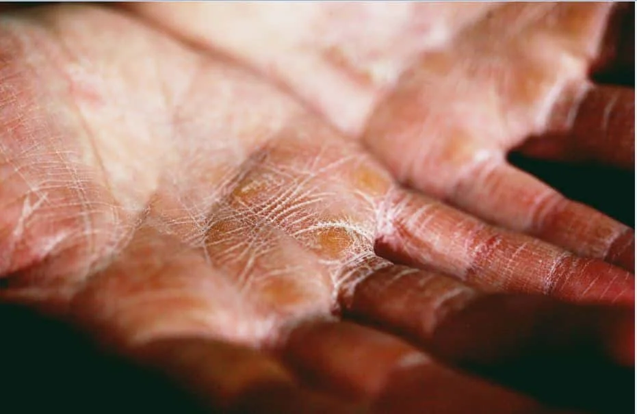 dry-skin